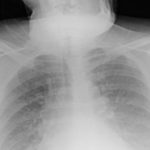 Studio del “Molinette” di Torino: ecografia polmone può diagnosticare Covid